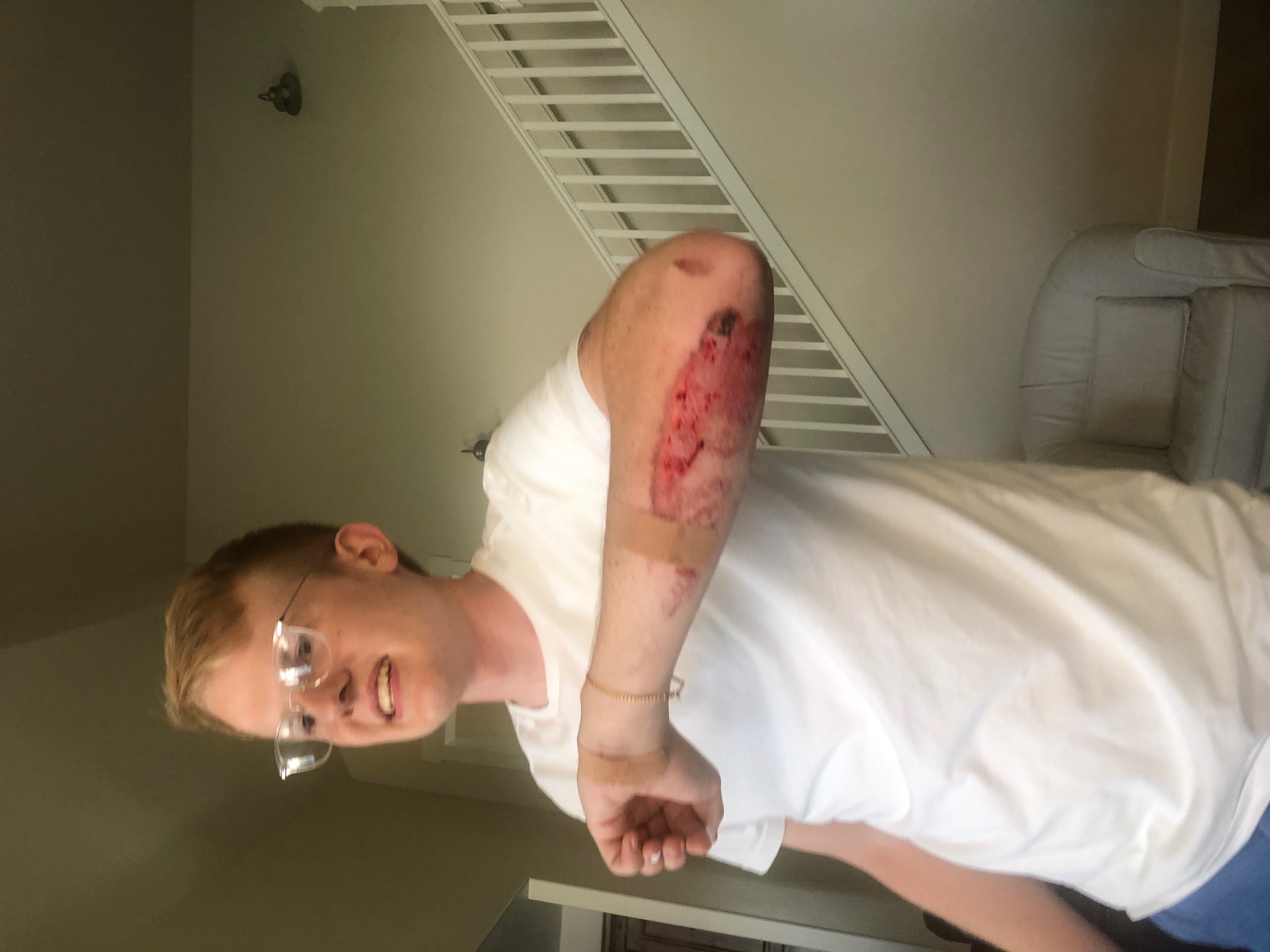 My bloody arm after an accident